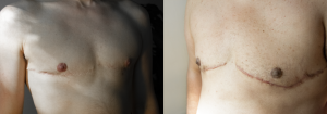 self-adhesive nipples (ftm)